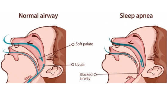 Diagram comparing normal airway and blocked airway in sleep apnea condition.